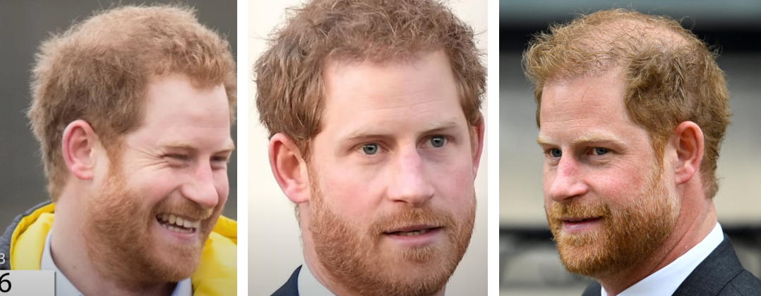 Prince Harry hair transplant featured image