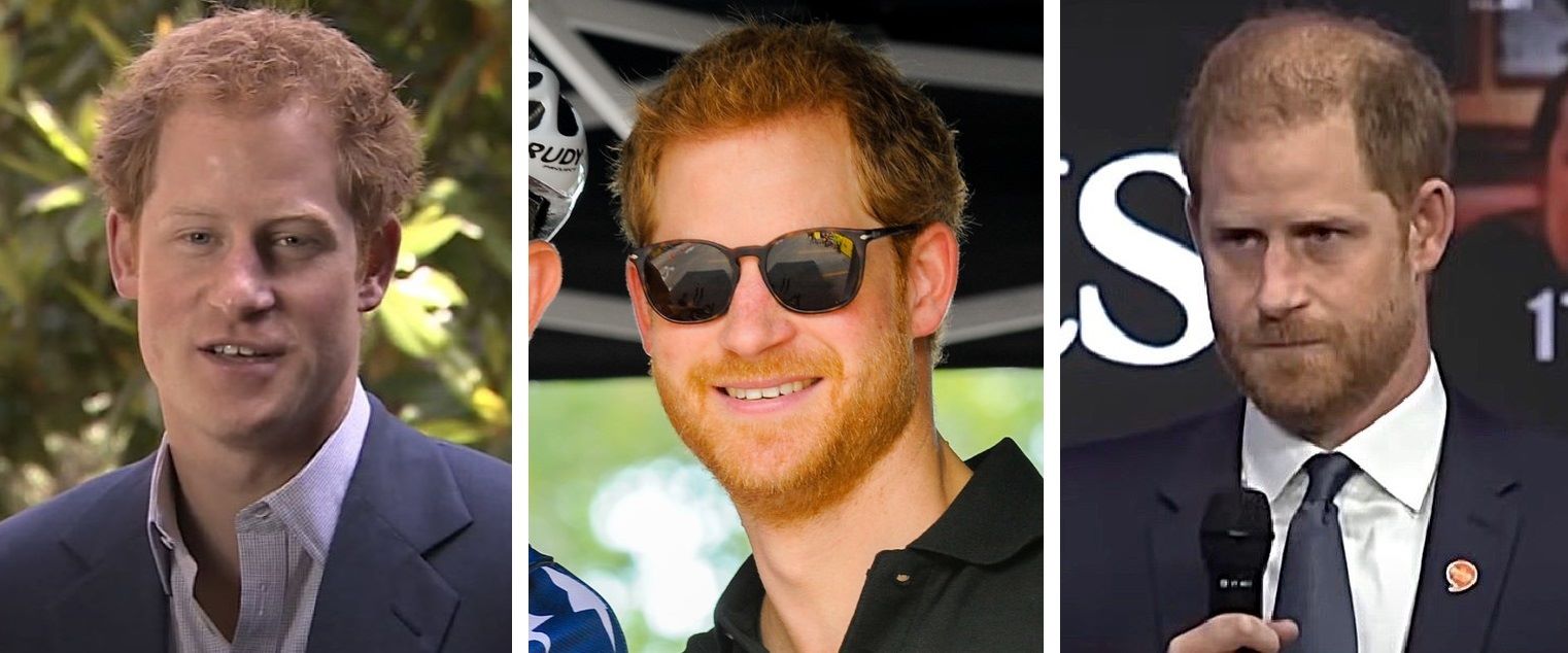 Prince Harry hair transplant