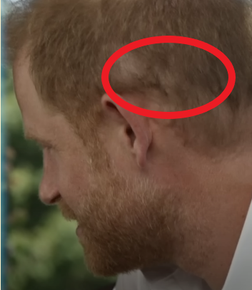 Prince Harry's scalp scar