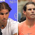 Rafael Nadal Hair Transplant: Everything You Need To Know