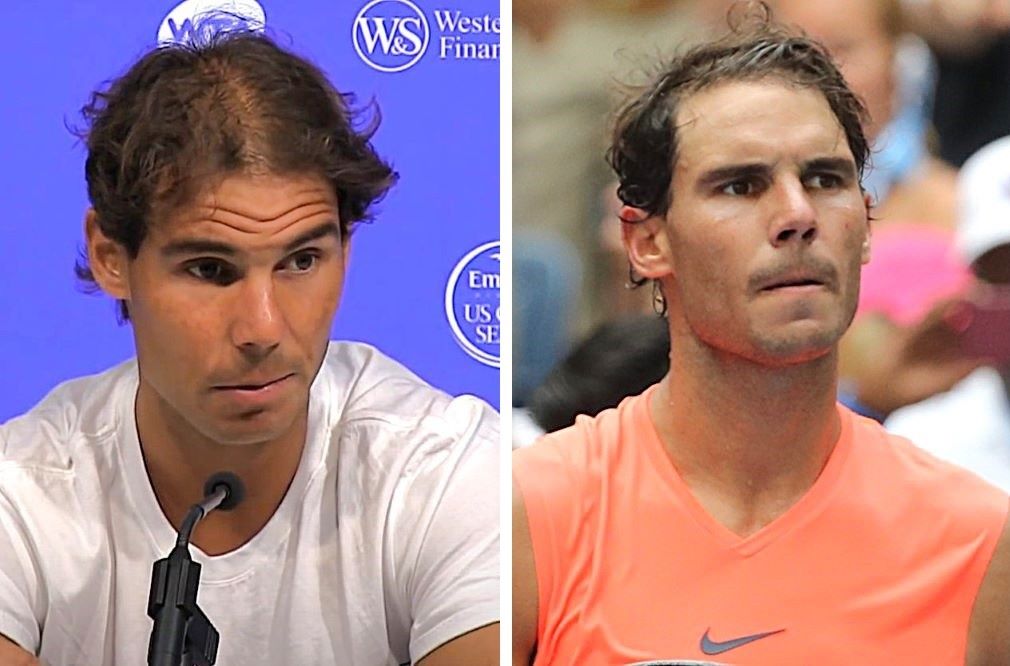 Rafael Nadal hair transplant