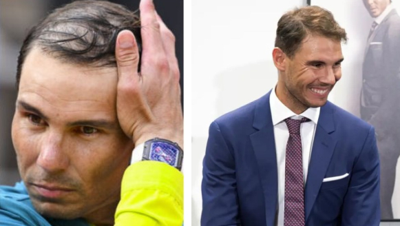 Rafael Nadal before and after hair transplant