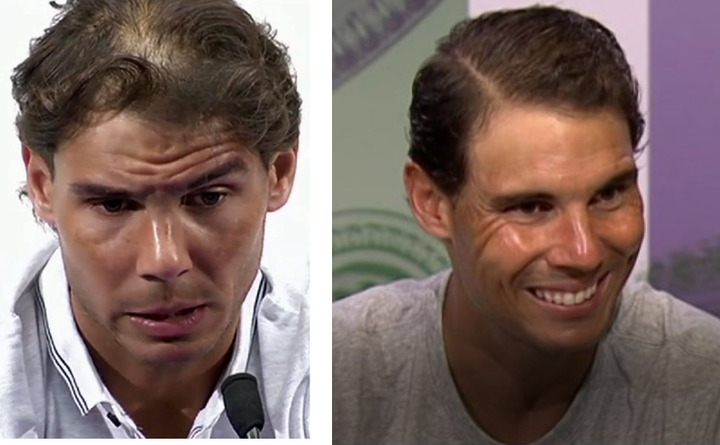 Rafael Nadal Hair Transplant: Everything You Need To Know