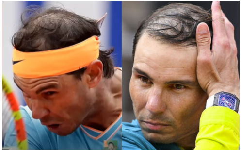 Rafael Nadal Hair Transplant: Everything You Need To Know, Wimpole Clinic