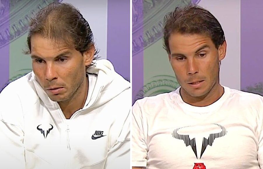Rafael Nadal's hair in 2015 (left) and in 2017 (right)