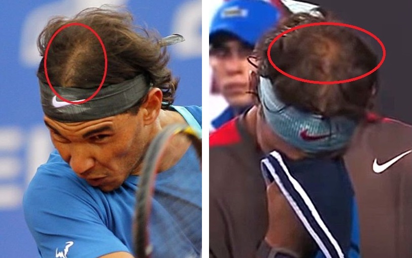 Rafael Nadal's hair loss