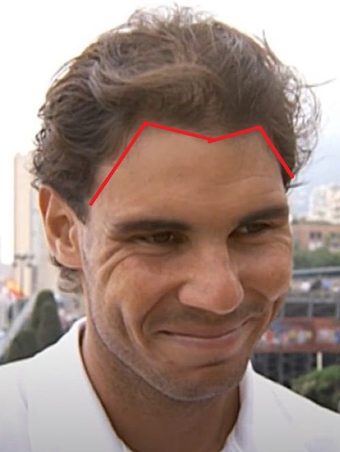 Rafael Nadal's m-shaped hairline