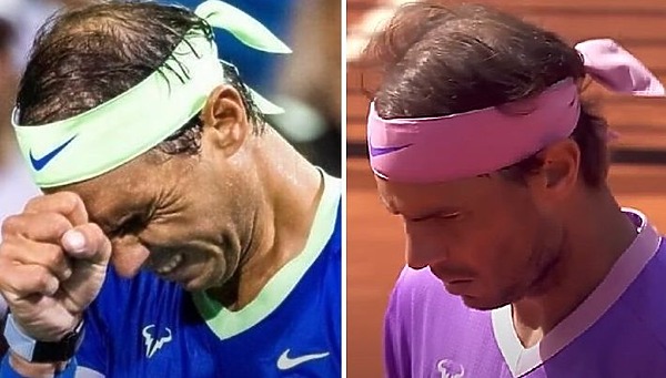Rafael Nadal Hair Transplant: Everything You Need To Know
