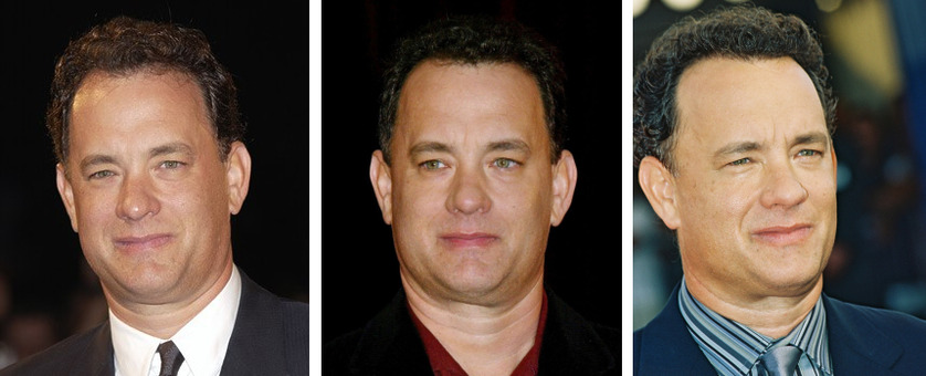 Tom Hanks’ Hair Transplant: Everything You Need to Know