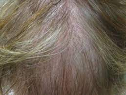 diffuse hair thinning around the crown