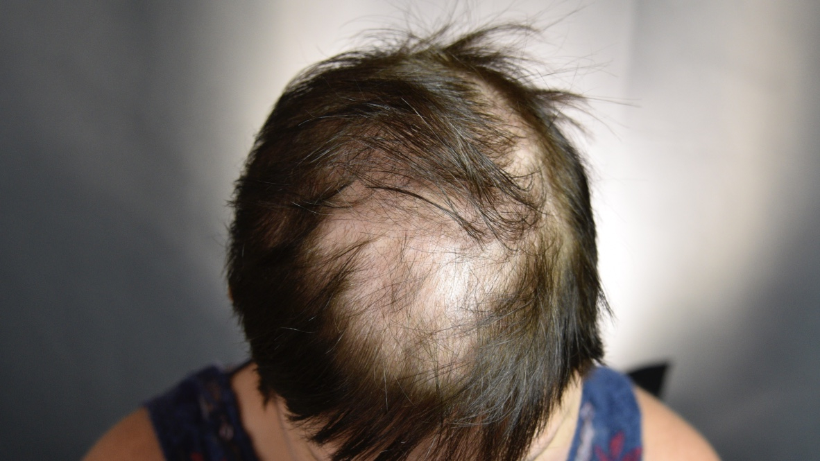 example of bald spot on top of the head