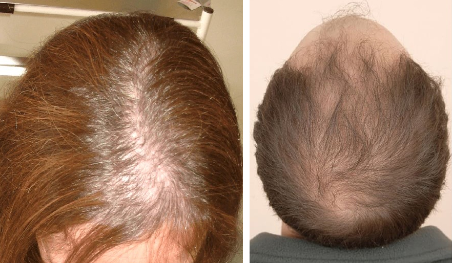 Female pattern baldness (left); male pattern baldness (right).