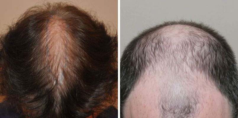 female pattern baldness vs male pattern baldness