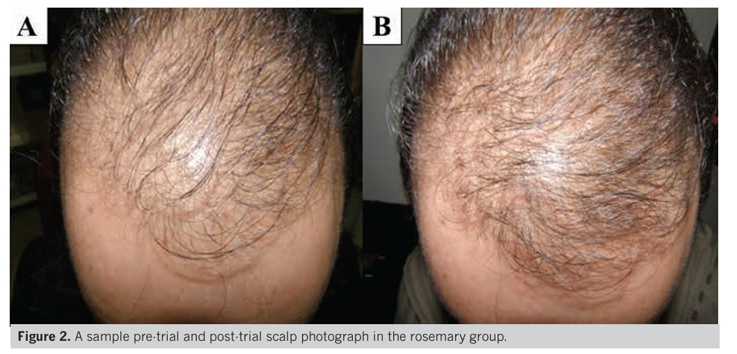 hair growth results before using rosemary oil and after