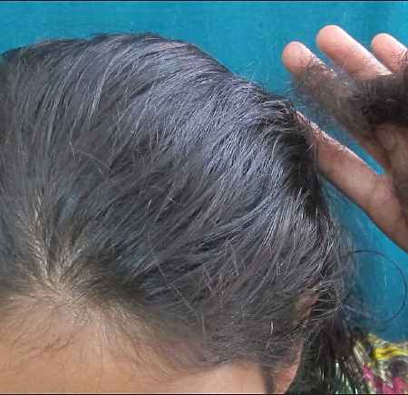 hair shedding from telogen effluvium