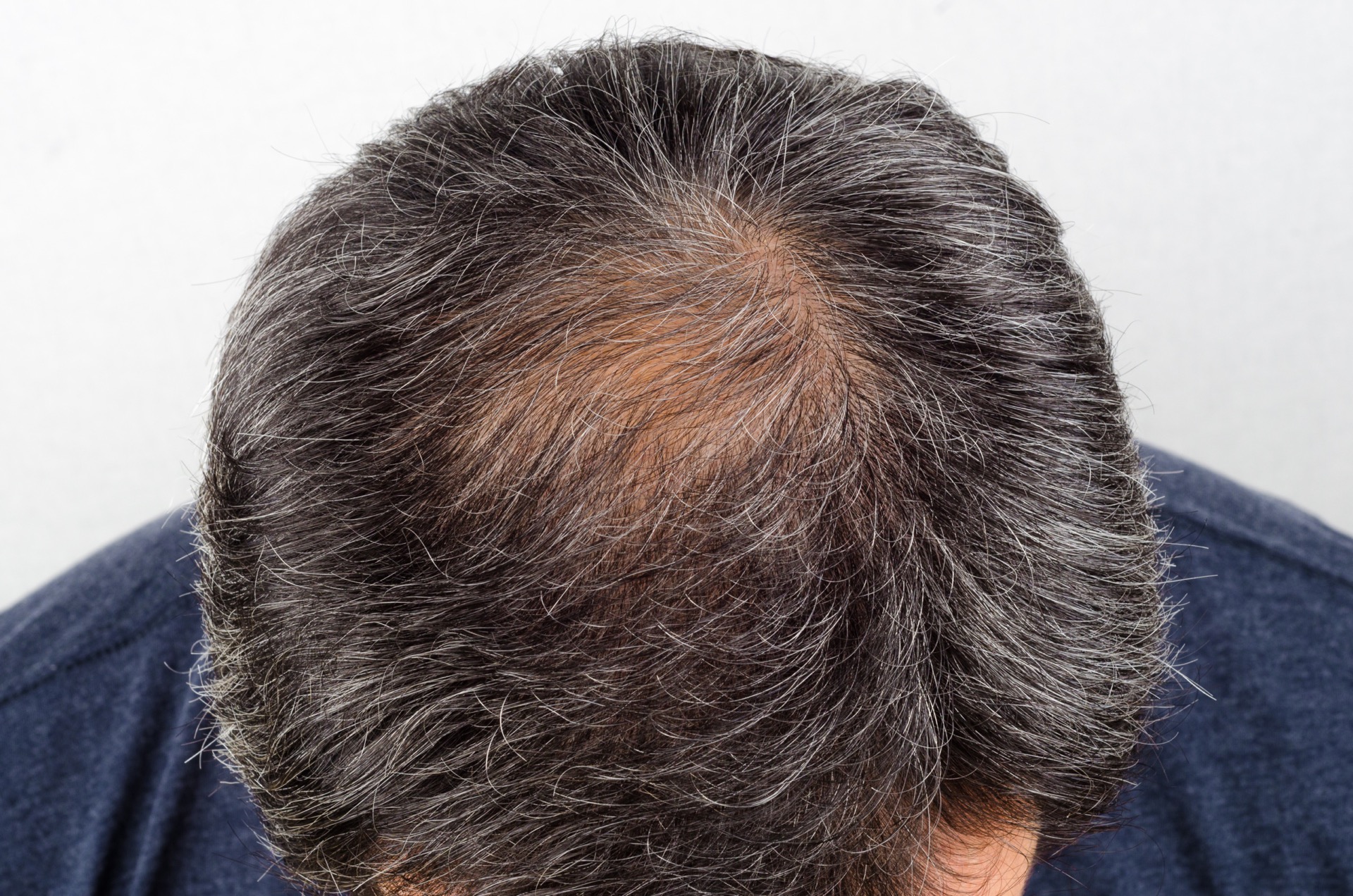 man with thinning hair on the crown