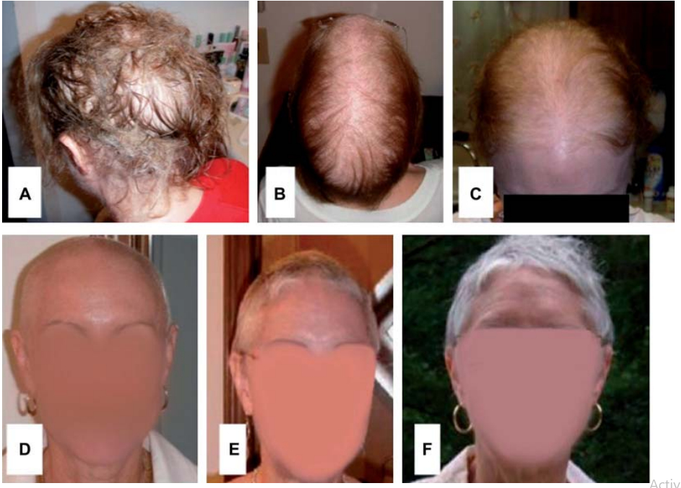 progression of hair loss due to selenium toxicity