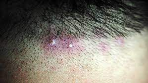 scalp acne
