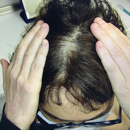 selenium toxicity induced hair loss
