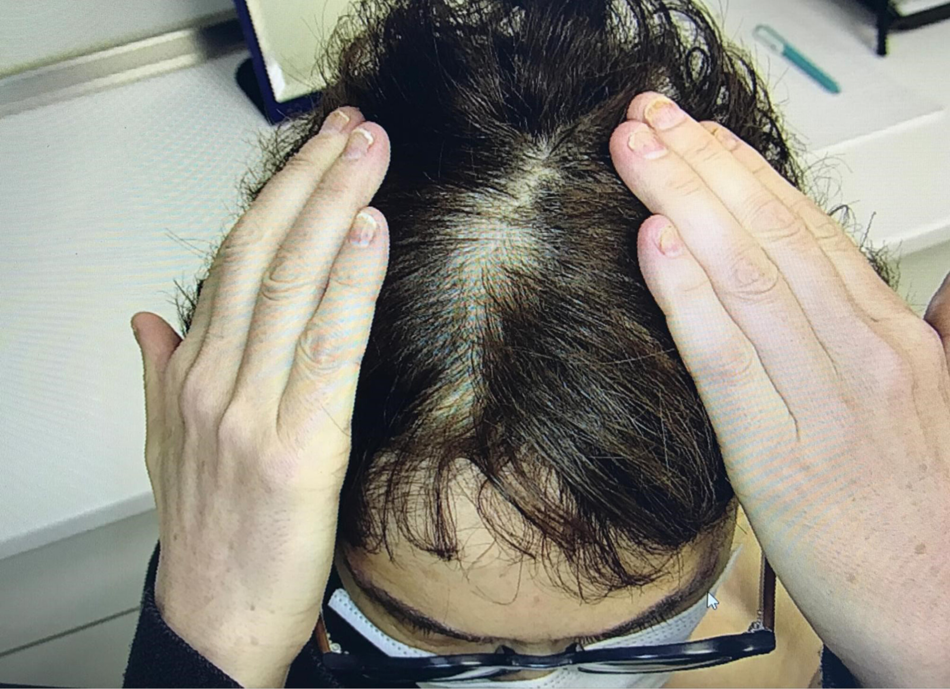 selenium toxicity induced hair loss