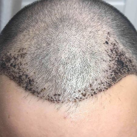 5 Reasons Your Scalp May Be Itching After A Hair Transplant