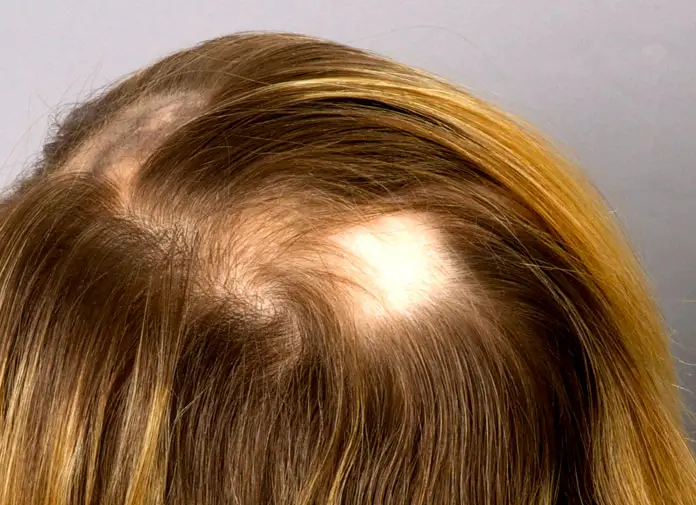 Alopecia areata in an adolescent girl