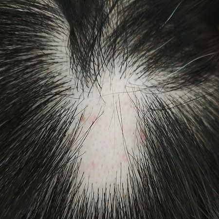 Alopecia areata on the scalp