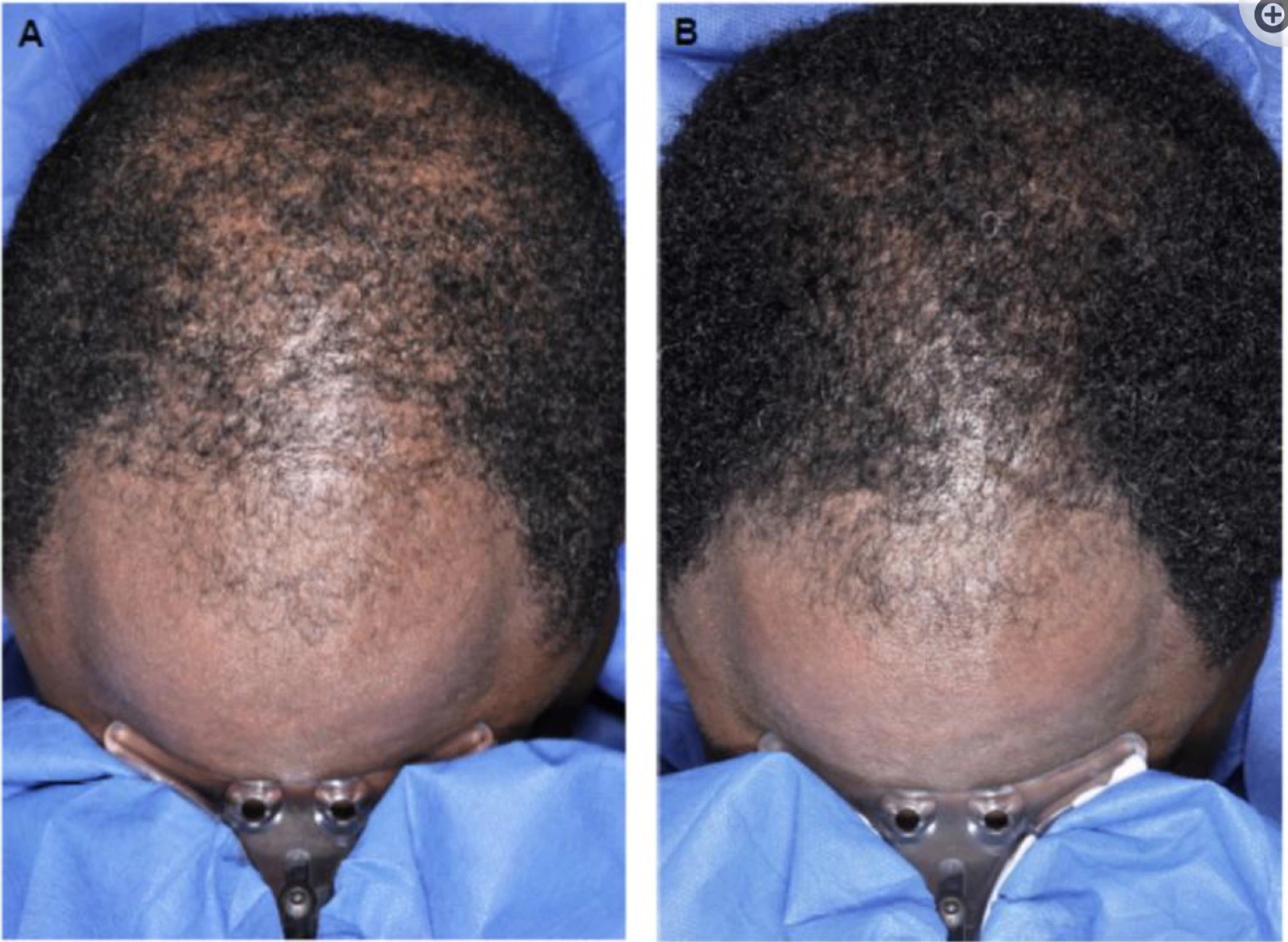 Before and after eight weeks of using 5% Minoxidil foam twice a day