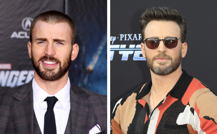Chris Evans before and after hair restoration