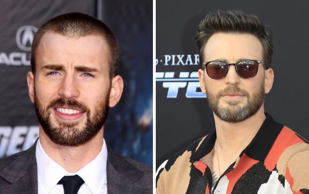 Chris Evans' changed hairline