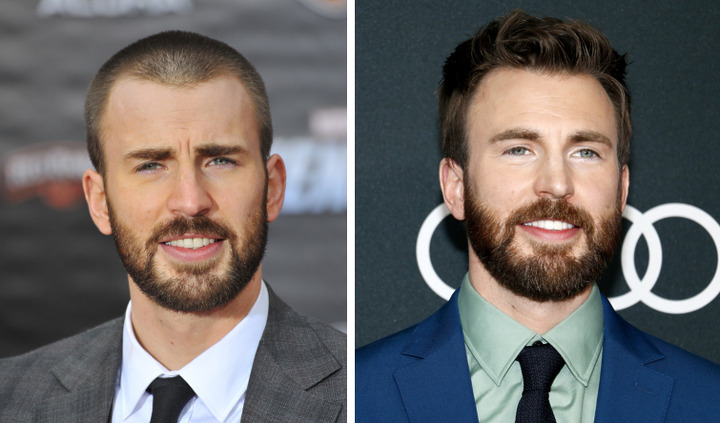 Chris Evans’ Hair Transplant - Everything you need to know