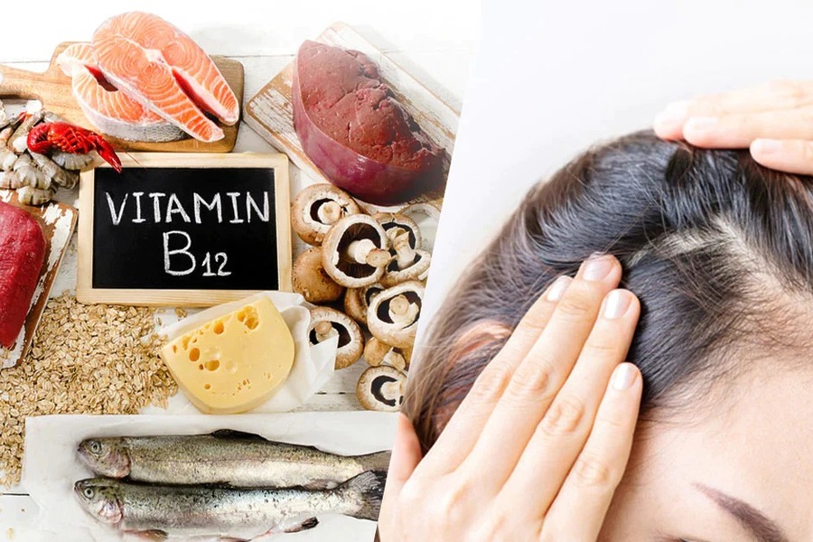 Does Vitamin B12 Deficiency Cause Hair Loss Or Is It A Myth?
