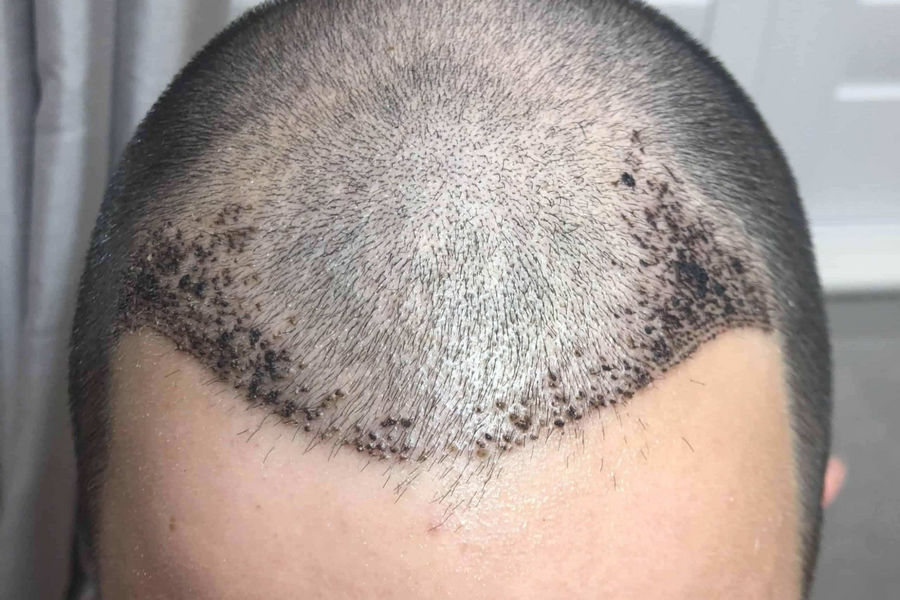 Itching After A Hair Transplant Featured Image