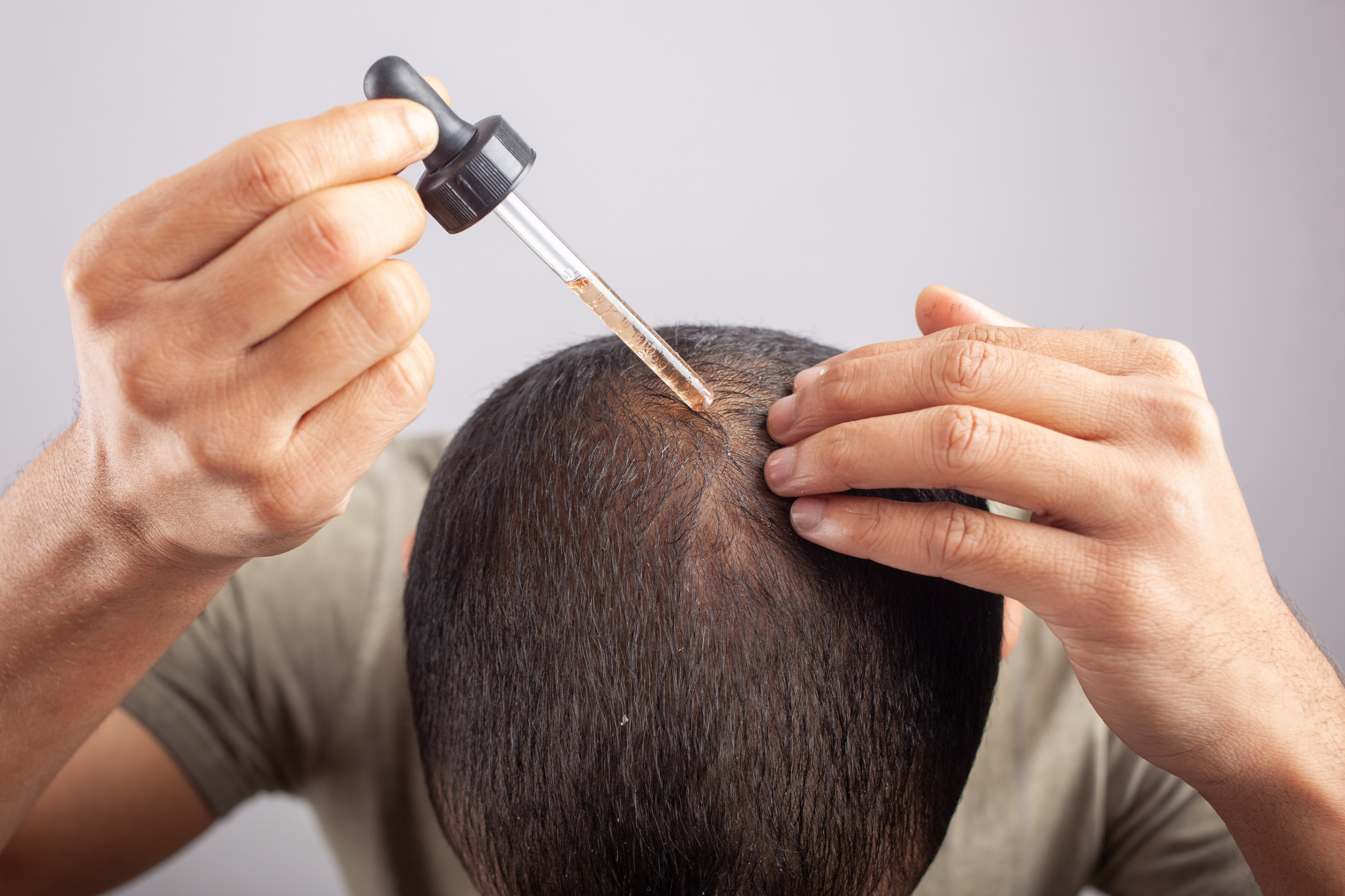 Man using minoxidil on bald scalp to treat hair loss