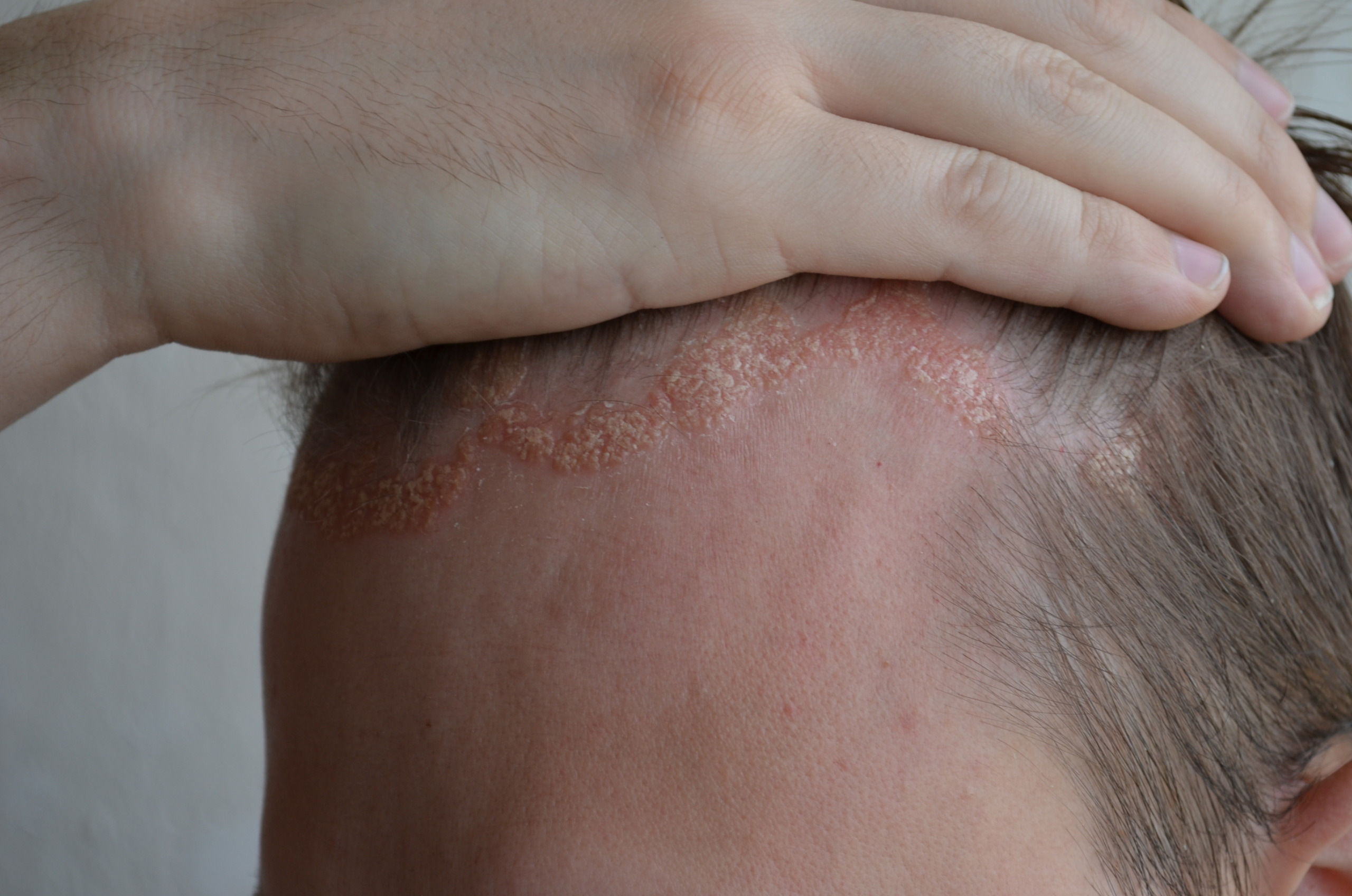 Psoriasis on the hairline