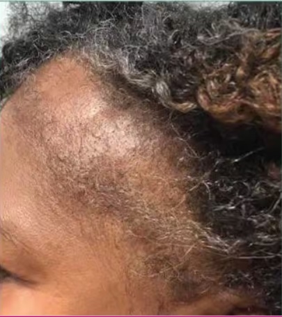 Woman with traction alopecia