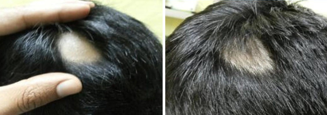 alopecia areata before and after using Rogaine