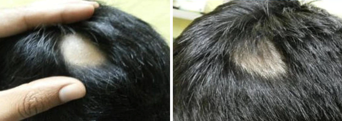 Before and after using Minoxidil to treat alopecia areata