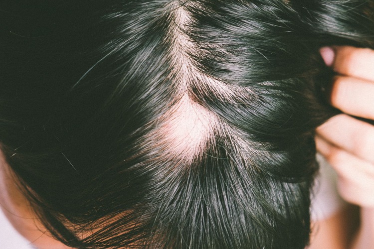 patchy hair loss caused by alopecia areata
