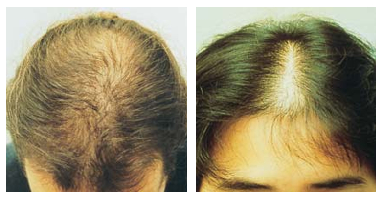 early male pattern baldness (left) and female pattern baldness (right) in 18 year olds