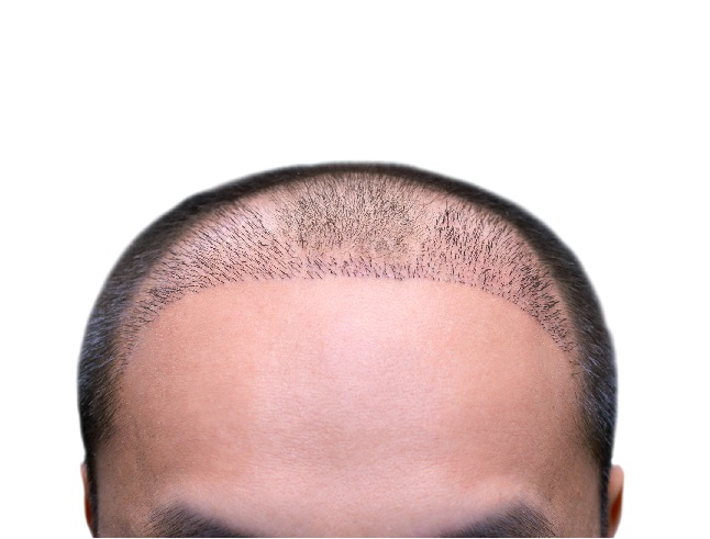 new hair growing into implanted areas post hair transplant
