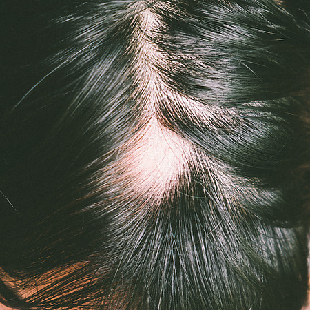 patchy hair loss due to alopecia areata
