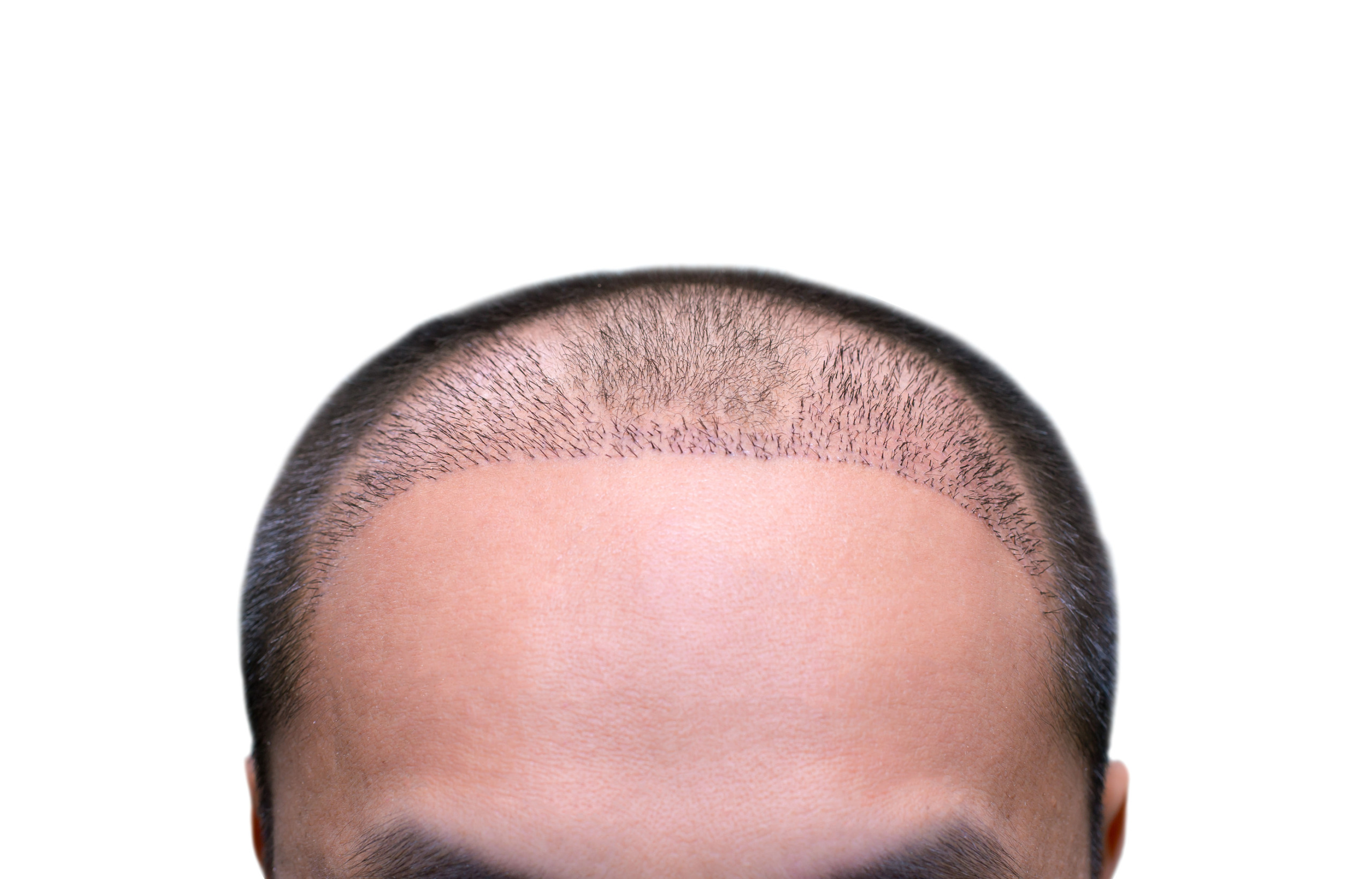 receding hairline after hair transplant surgery