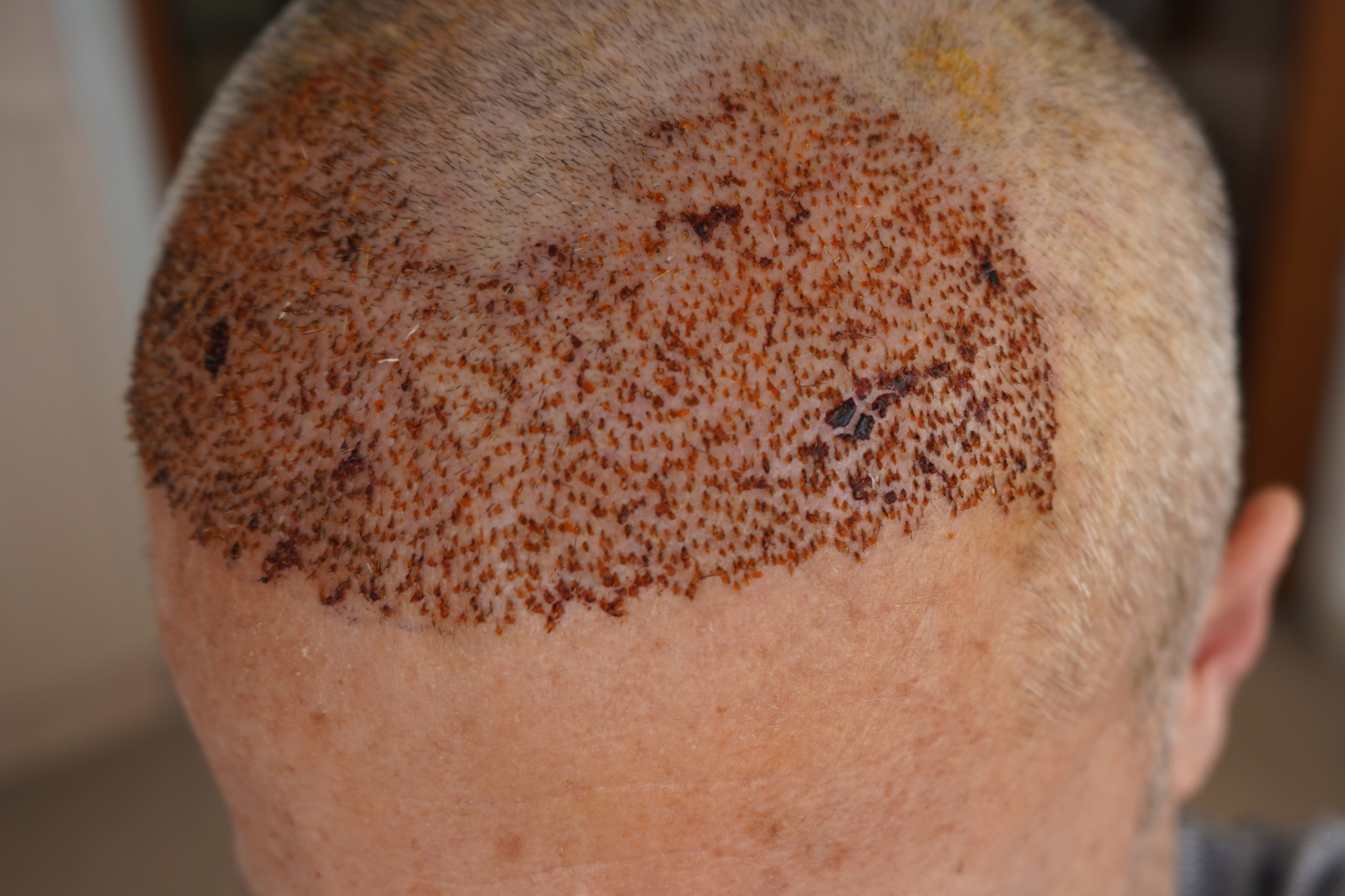 scabs 5 days after hair transplant
