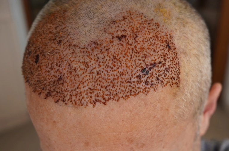 scabs 5 days after hair transplant surgery