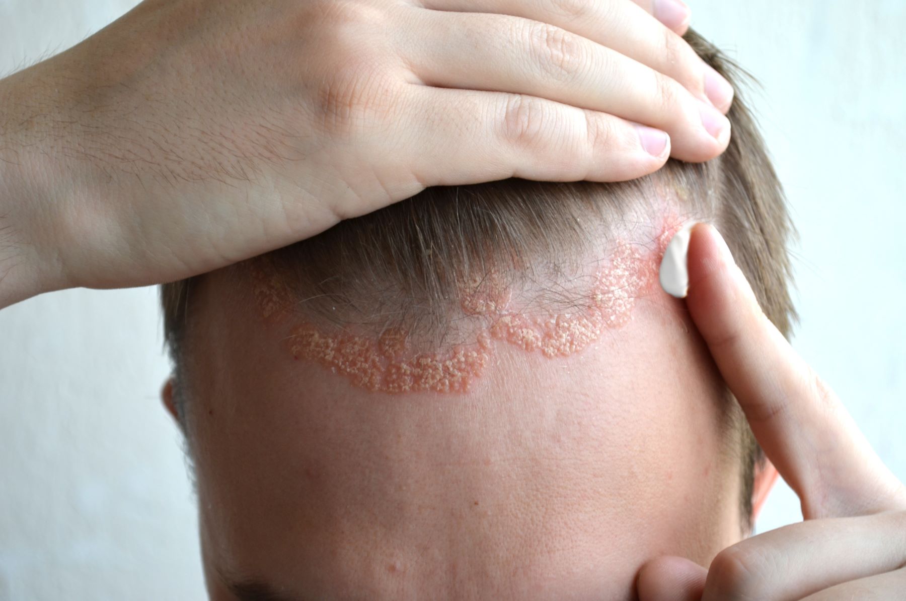 scalp psoriasis on a young person