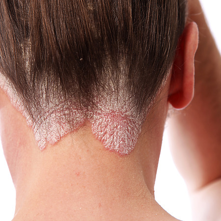 scalp psoriasis on the hairline