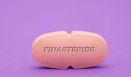 Are Finasteride Side Effects Permanent - Review