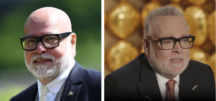 Gary Goldsmith before and after hair transplant