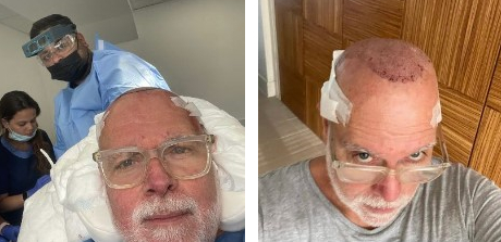Goldsmith post hair transplant surgery at the Wimpole Clinic